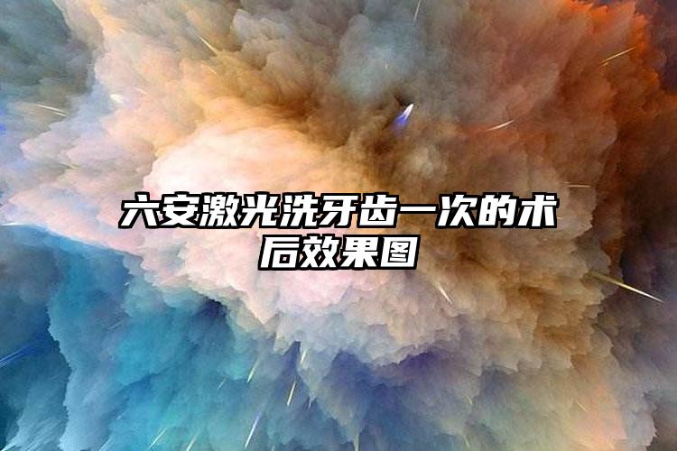 六安激光洗牙齿一次的术后效果图